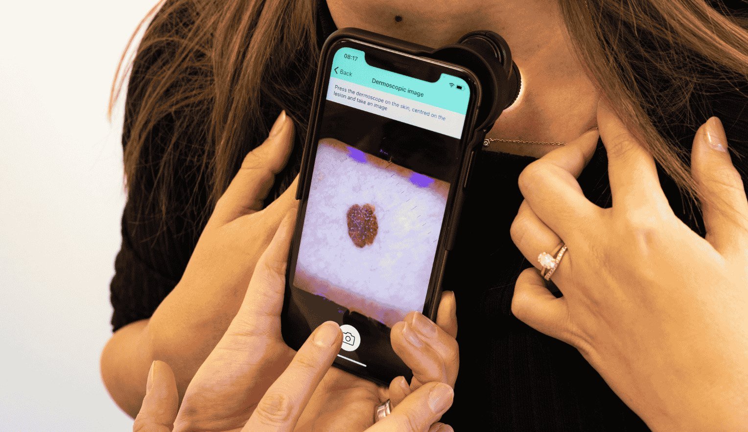 Skin Analytics announcement image for the NHS England South East rollout of its DERM skin cancer AI